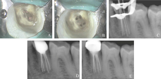 Endodontics Treatment